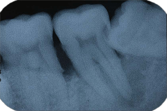 50歳　男性　歯周炎治療症例⑦