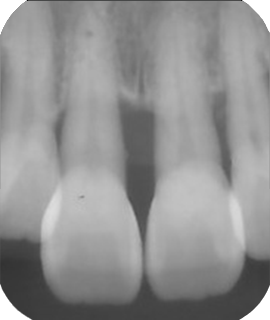 46歳　女性　歯周外科治療症例11